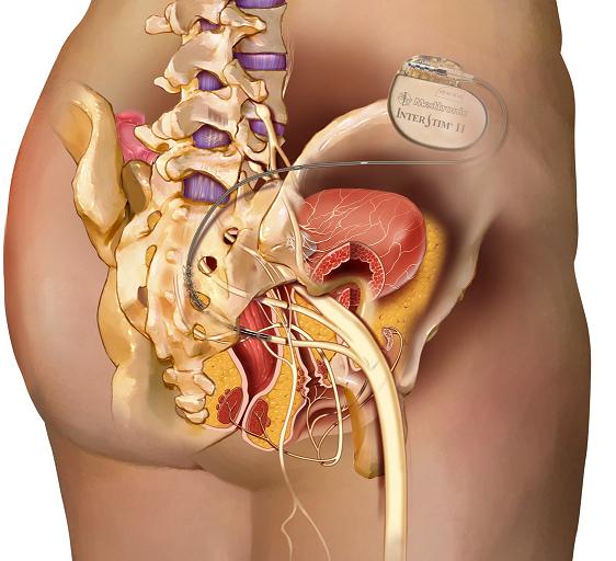 What bladder problems does InterStim help treat?